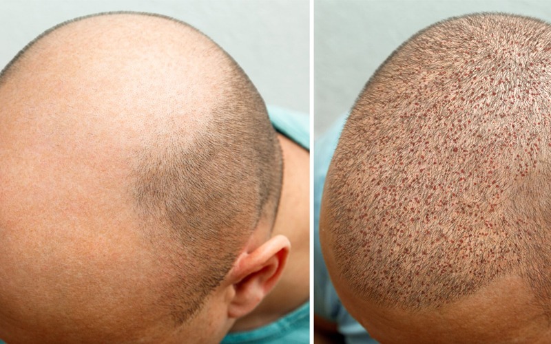 hair transplant