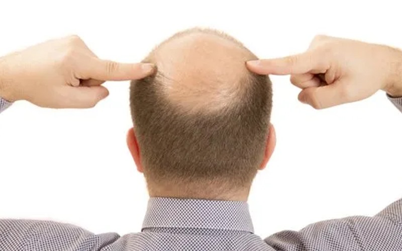 hair transplant