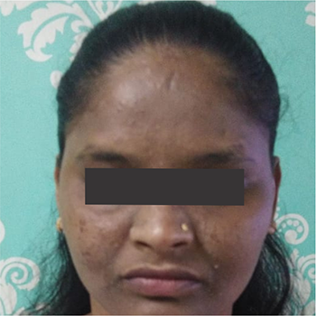 Yellow_Peel_01_Before