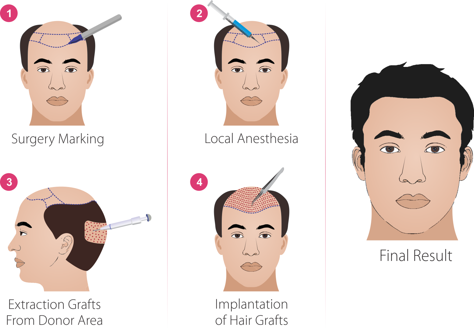 hair transplant