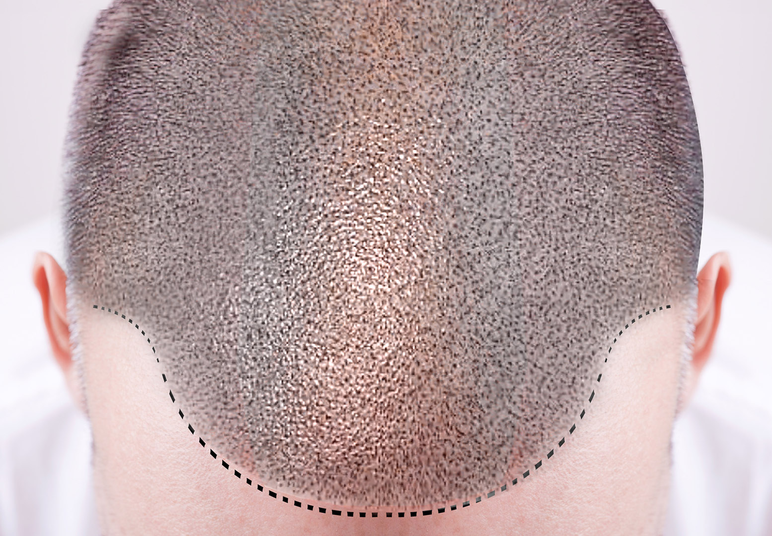 Scalp Micropigmentation