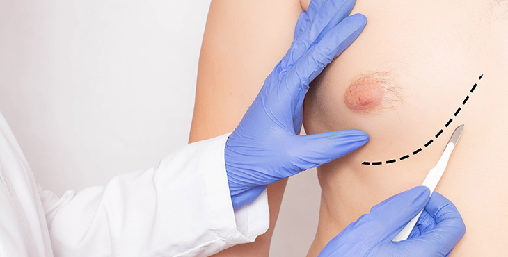 gynecomastia