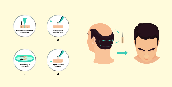 Follicular Unit Extraction