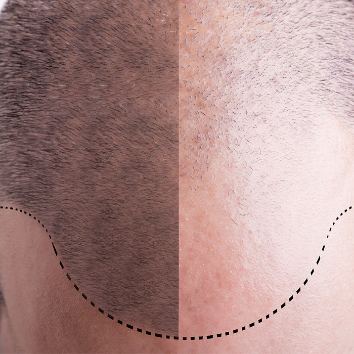 Male Hair Transplant