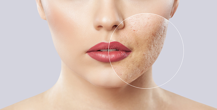 laser scar reduction