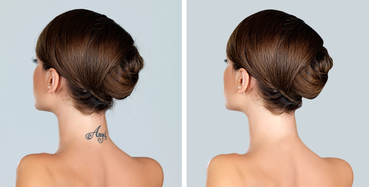 laser tattoo removal